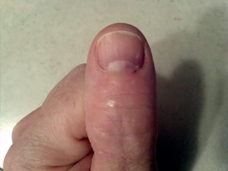 thumb_trauma.jpg