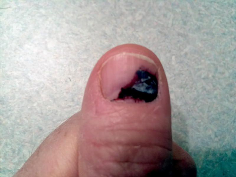 thumb+trauma4.jpg