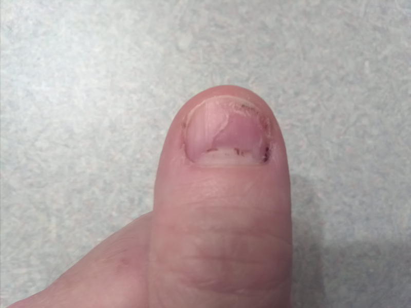 thumb_trauma5.jpg